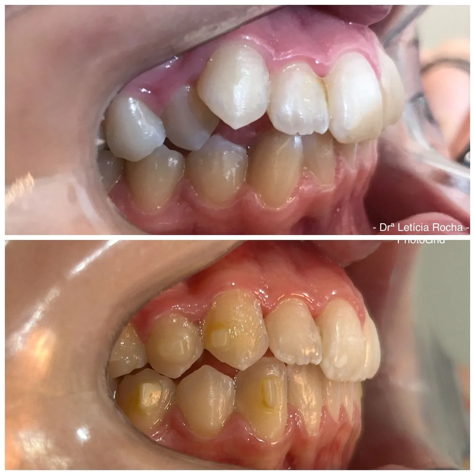 Antes e depois alinhadores invisíveis — caso Violeta
