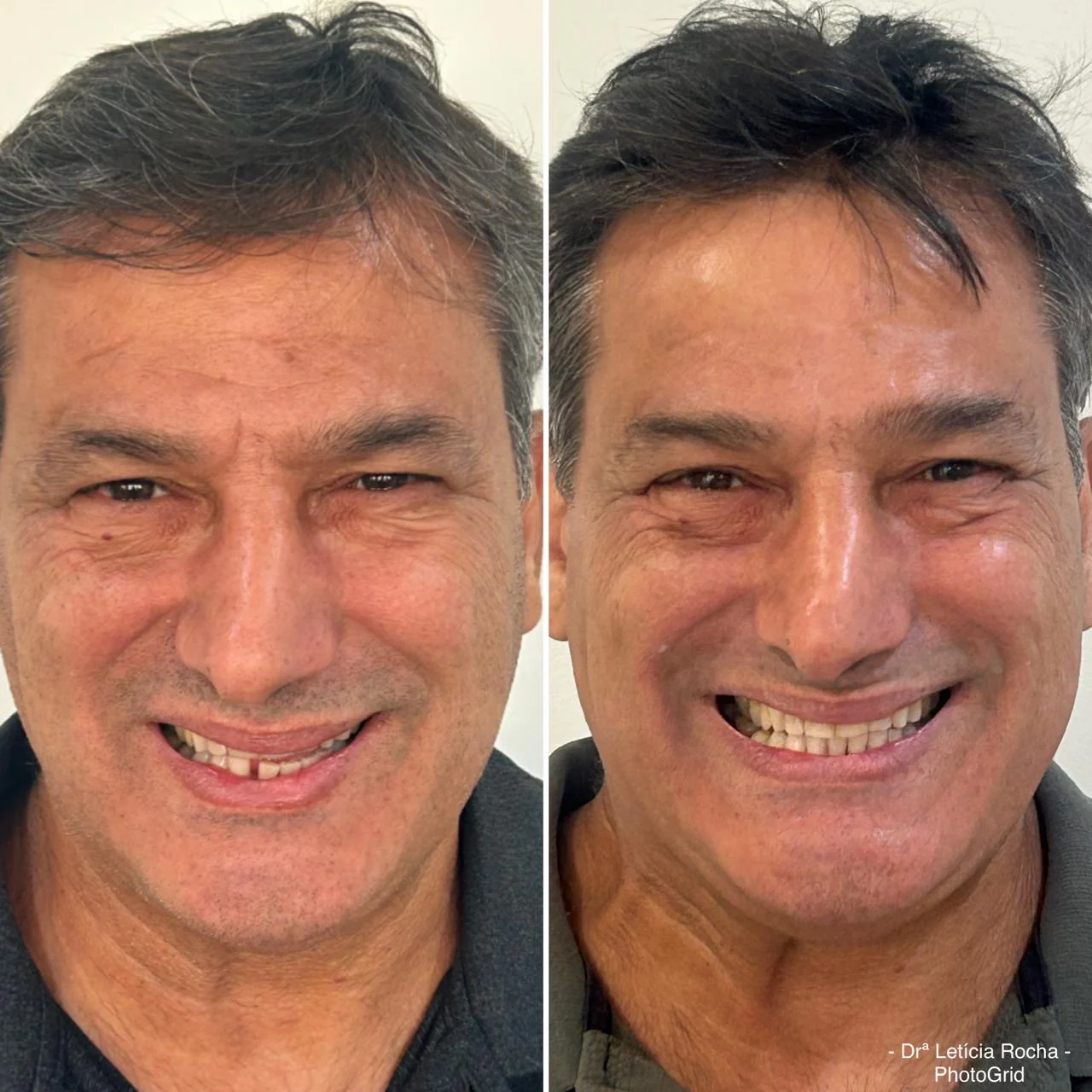 Antes e depois aparelho invisível — Adilson