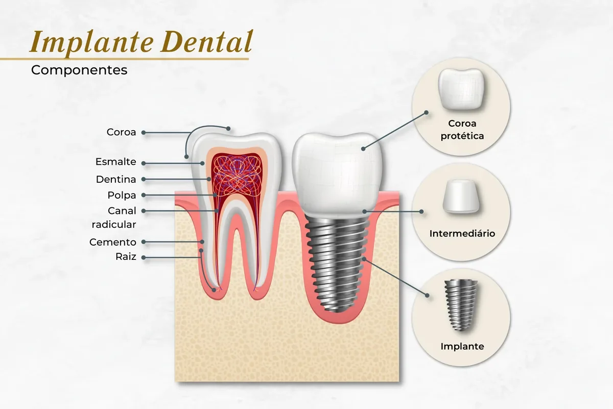 Componentes do implante dentário: pino, intermediário e coroa — Abilità, Lago Norte, Brasília