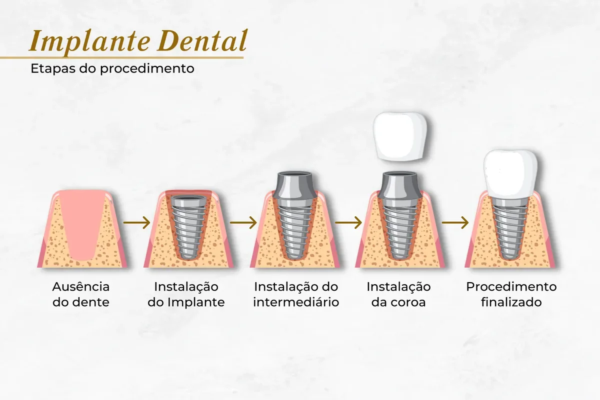 Etapas do implante dentário: ausência do dente, instalação do implante, intermediário, coroa e finalização — Abilità, Brasília