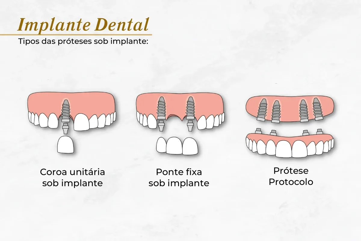 Tipos de implante dentário: unitário, protocolo e implantes múltiplos — Abilità, Lago Norte, Brasília
