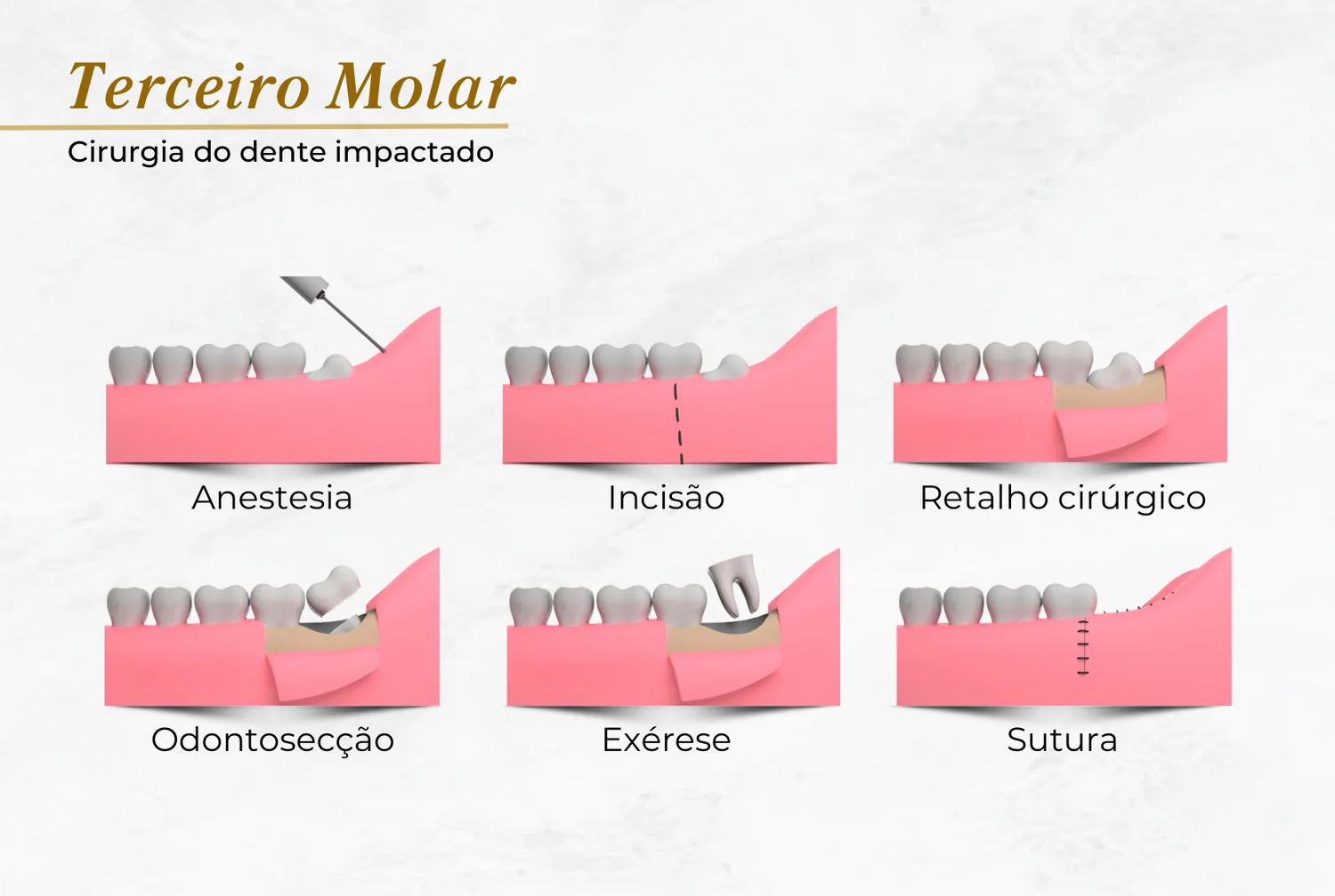 Etapas da cirurgia de siso: anestesia, incisão, retalho cirúrgico, odontosecção, exérese e sutura