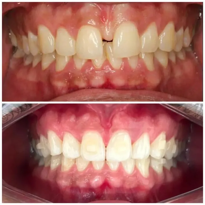 Antes e depois alinhadores &mdash; Gabriel