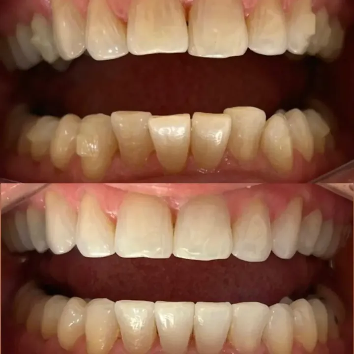 Antes e depois alinhadores &mdash; Maria Thereza