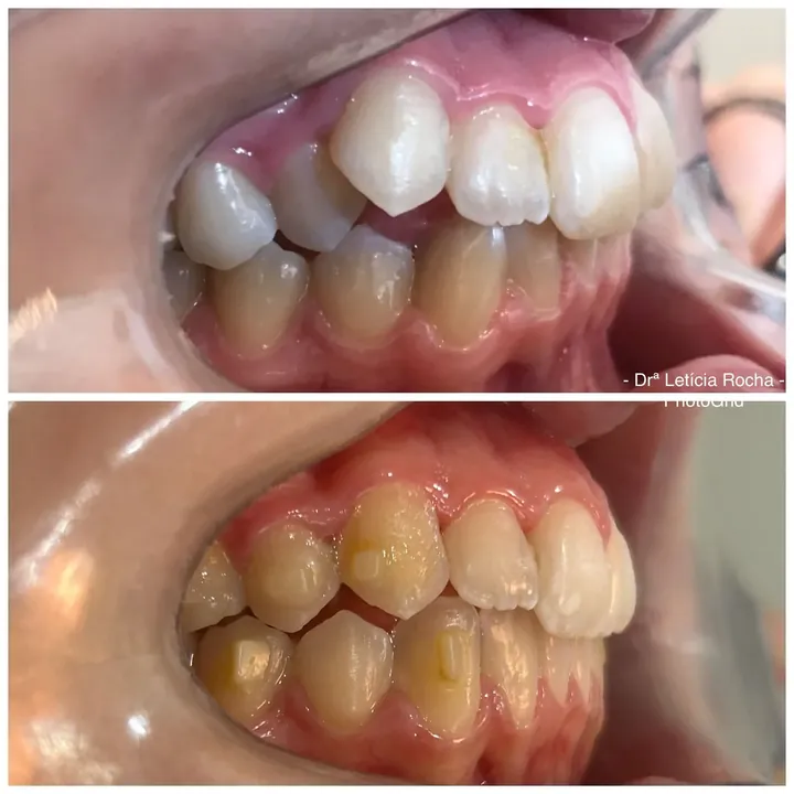 Antes e depois alinhadores &mdash; Violeta