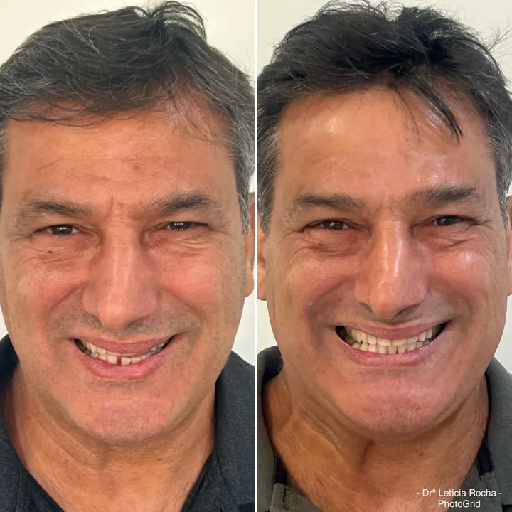 Adilson &mdash; antes e depois com aparelho invis&iacute;vel
